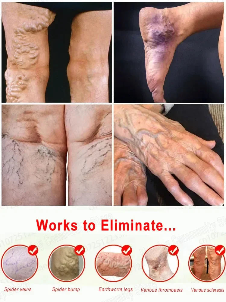Powerful Laser Therapy for Moderate Varicose Veins, Relieve