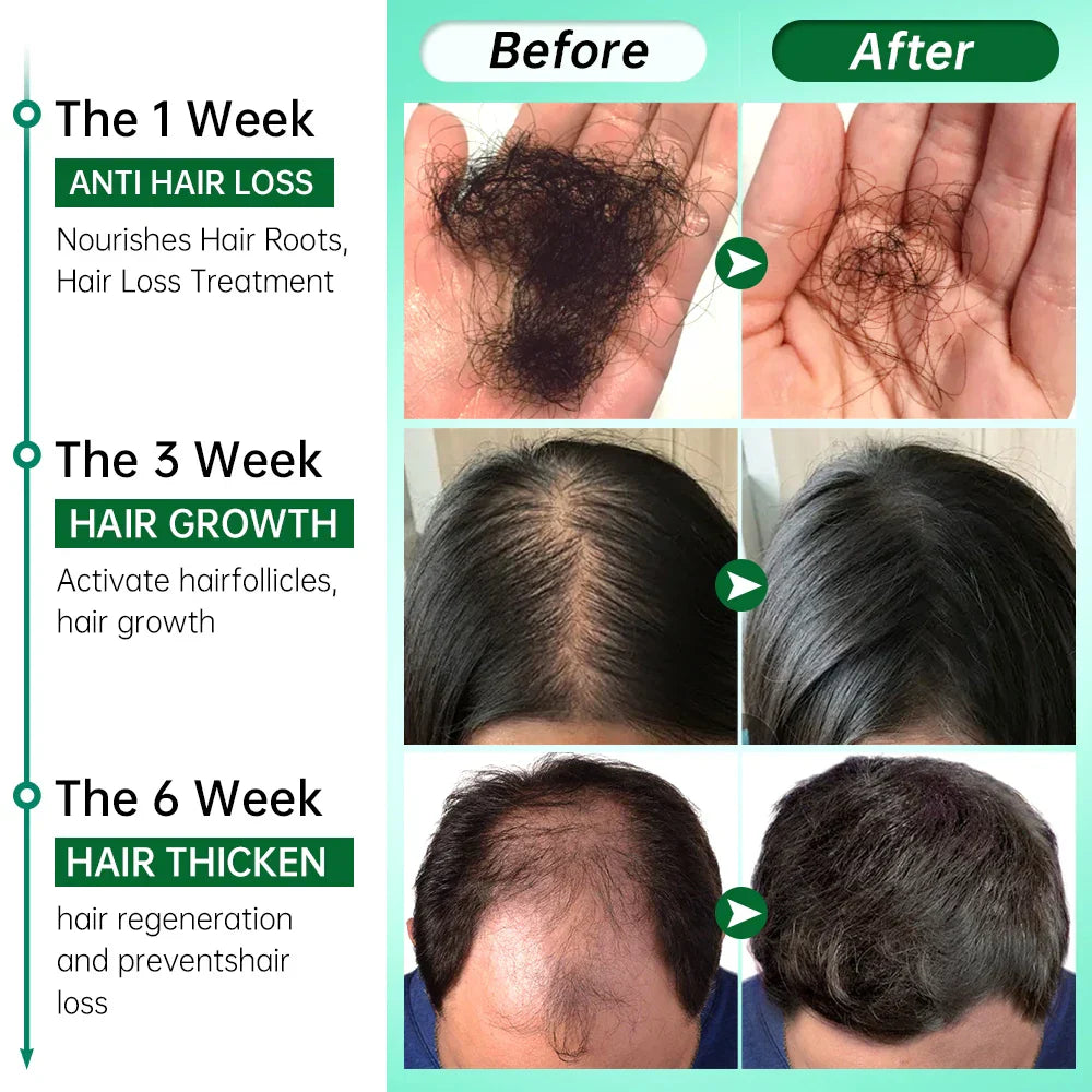 PURC Rosemary Oil Hair Growth for Men Women