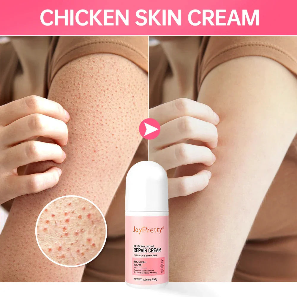 JoyPretty Body Cream Chicken Skin Removal Treatment Pore