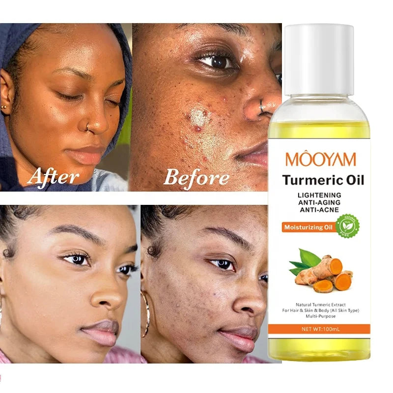 Turmeric Oil Face Whitening Lightening Acne Dark Patches