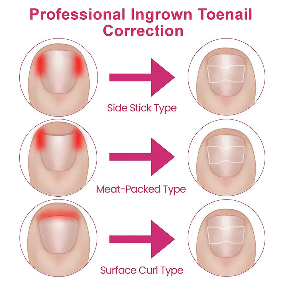 50/100pcs Ingrown Toenail Corrector Patches Nail Correction Care