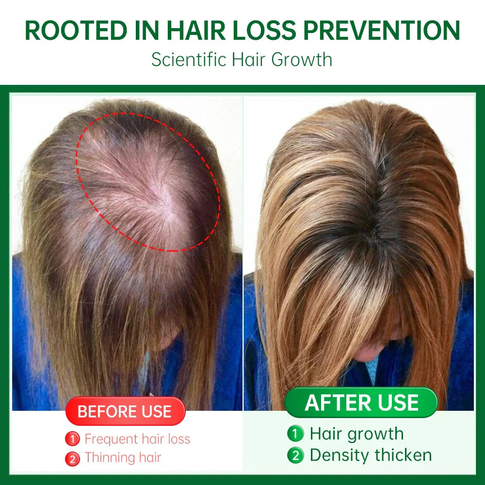 PURC Rosemary Oil Hair Growth for Men Women