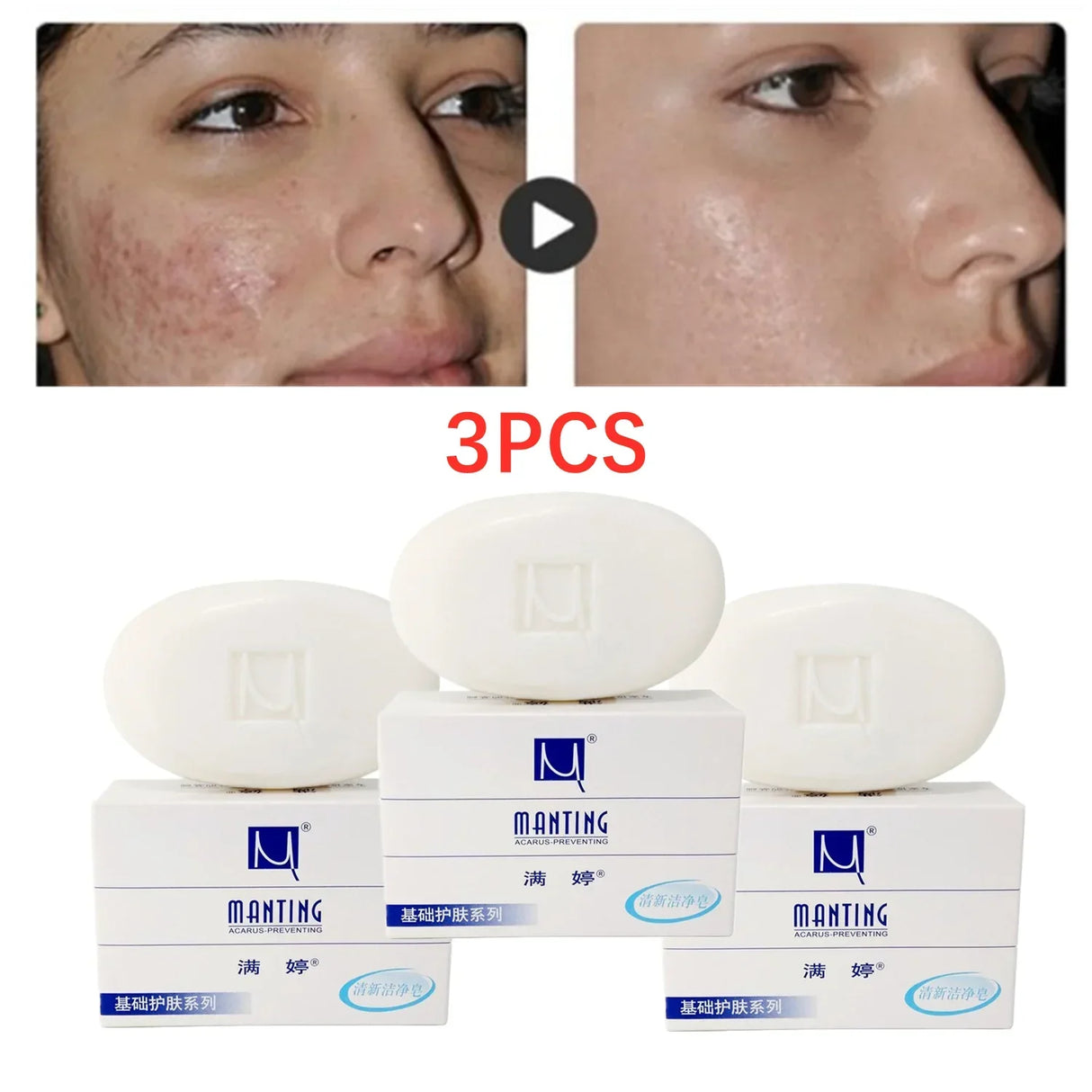 3X MANTING Mites Acarus Acari Removing Body Face