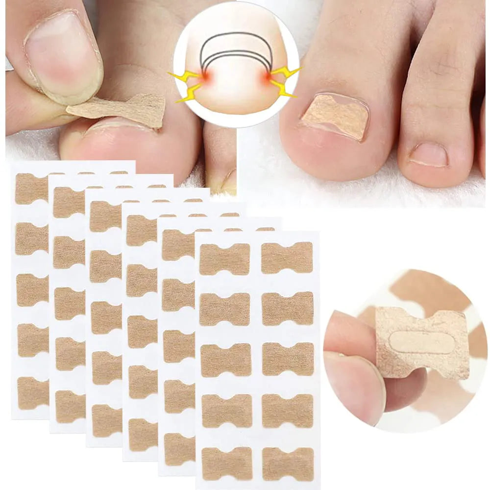 50/100pcs Ingrown Toenail Corrector Patches Nail Correction Care