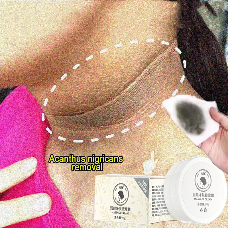 Anti Acanthosis Nigricans Whitening Cream Remove Melanin Armpit