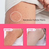 Body Cream Chicken Skin Removal Treatment Keratosis Pilaris