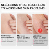 Body Cream Chicken Skin Removal Treatment Keratosis Pilaris