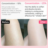 Body Cream Chicken Skin Removal Treatment Keratosis Pilaris