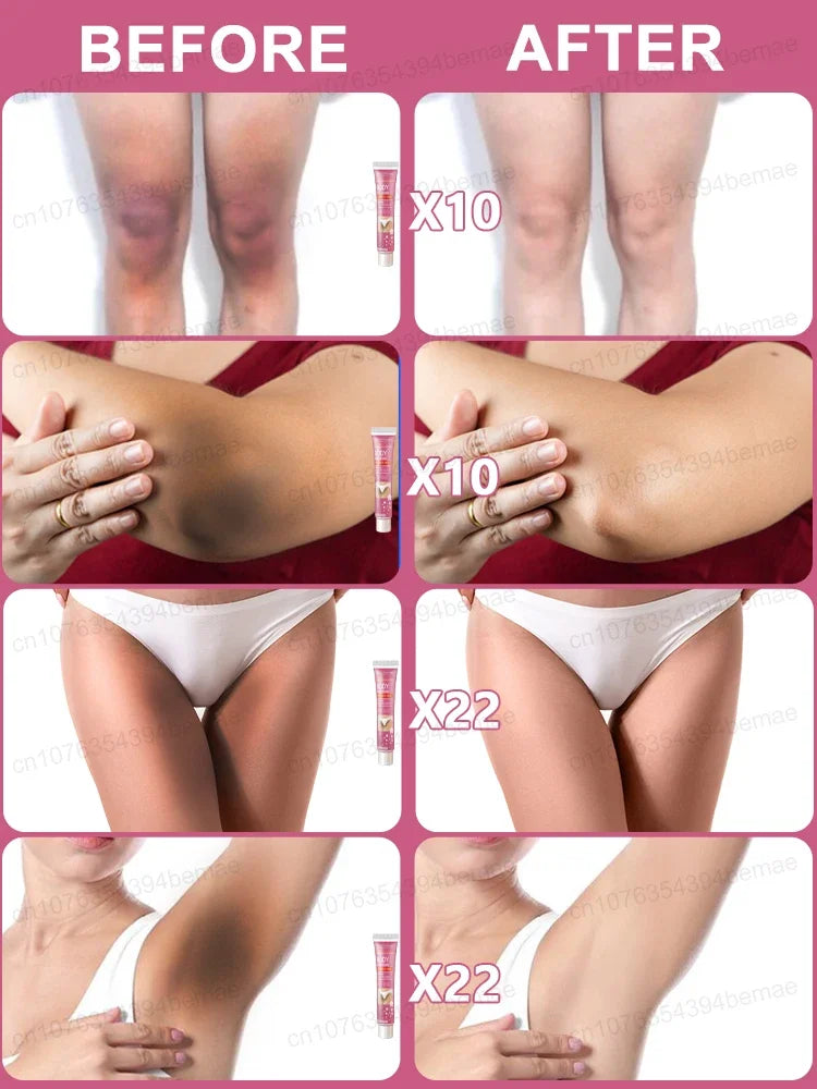 Body Whitening Cream Skin Pink Treatment Keratosis Pilaris