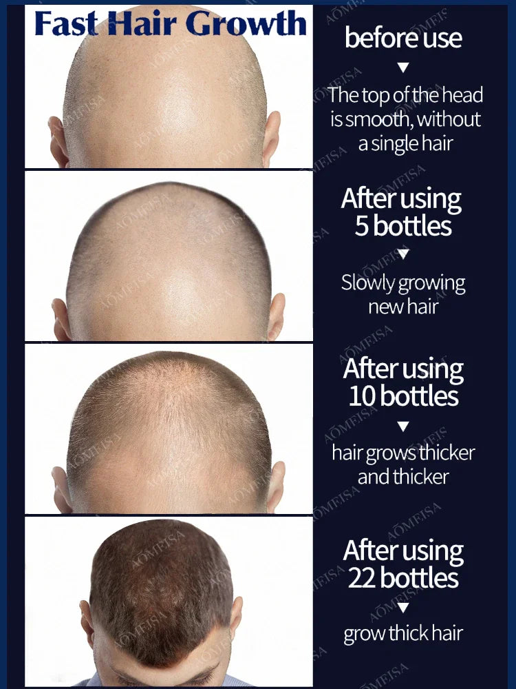 Hair growth oil,effective baldness repair, hereditary hair loss,