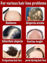 Hair growth oil,effective baldness repair, hereditary hair loss,