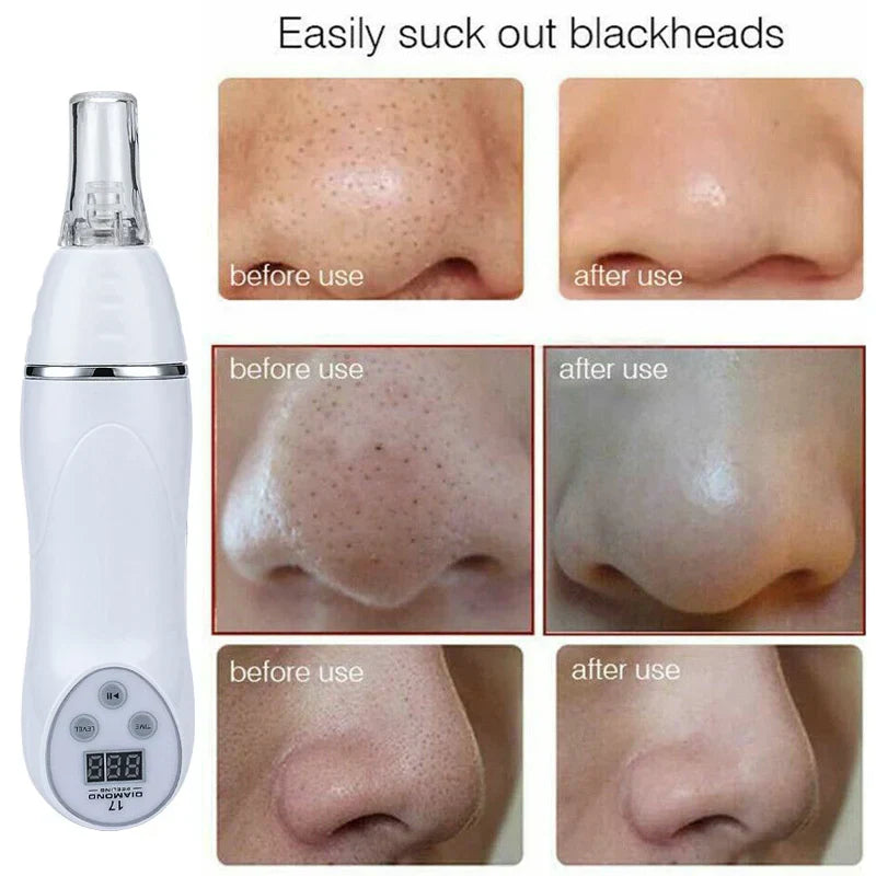 Home Use Blackhead Acne Removal Beauty Device Microdermabrasion