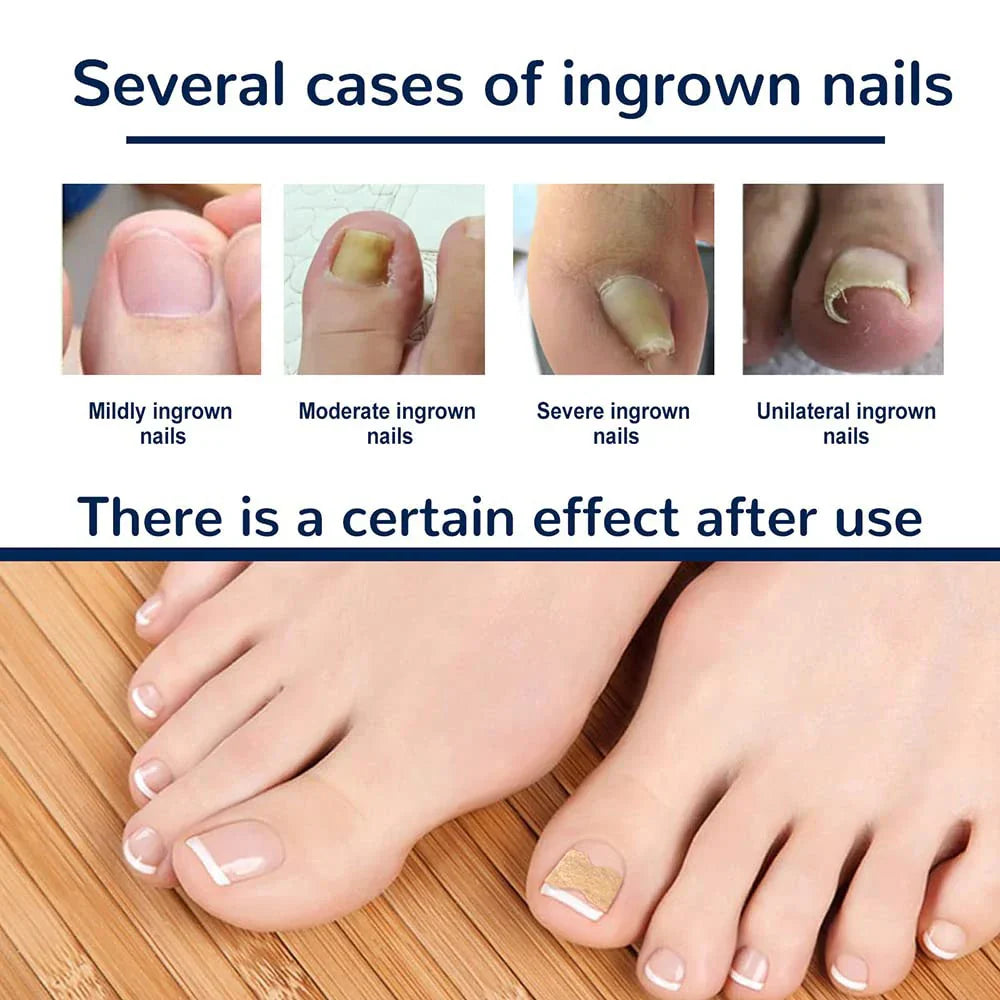 50/100pcs Ingrown Toenail Corrector Patches Nail Correction Care