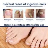 50/100pcs Ingrown Toenail Corrector Patches Nail Correction Care