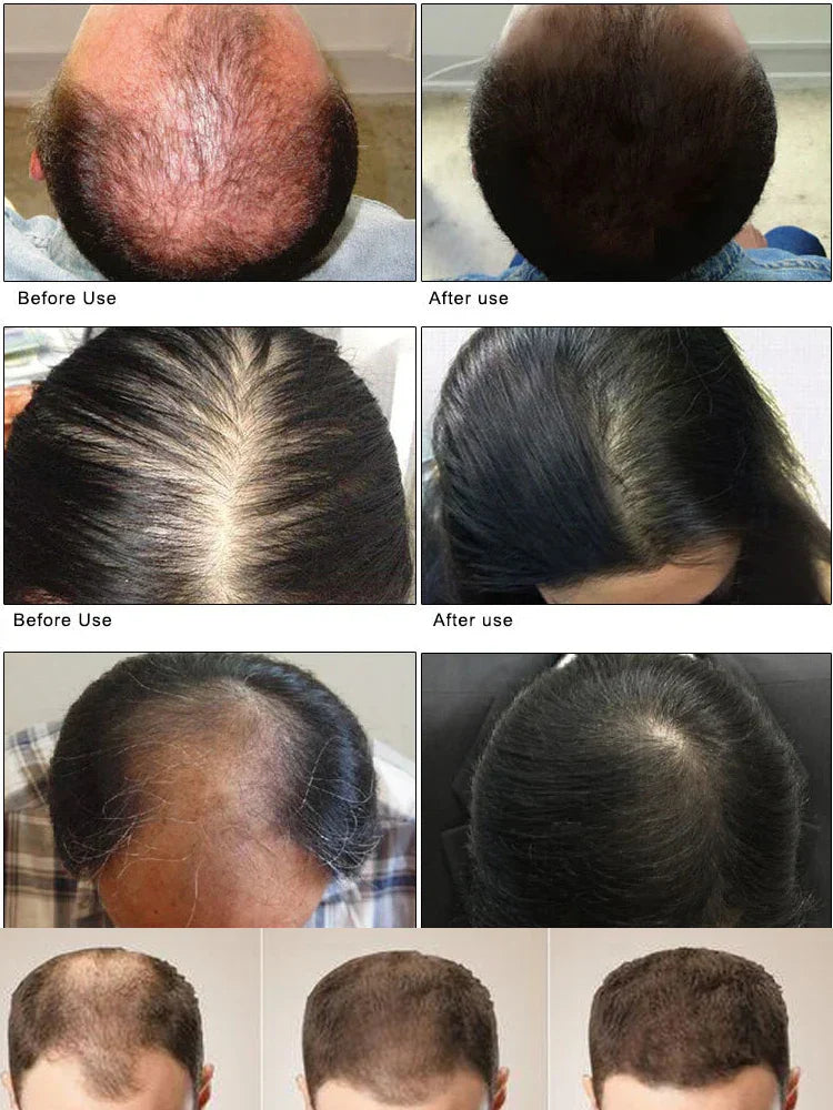 Fast Hair Growth Hair Growth Oil Effective Baldness