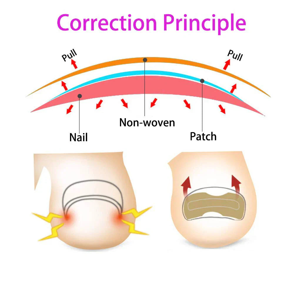50/100pcs Ingrown Toenail Corrector Patches Nail Correction Care