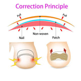 50/100pcs Ingrown Toenail Corrector Patches Nail Correction Care