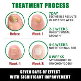 7DAYS Repair Nail Fungus Treatments Essence Foot Care