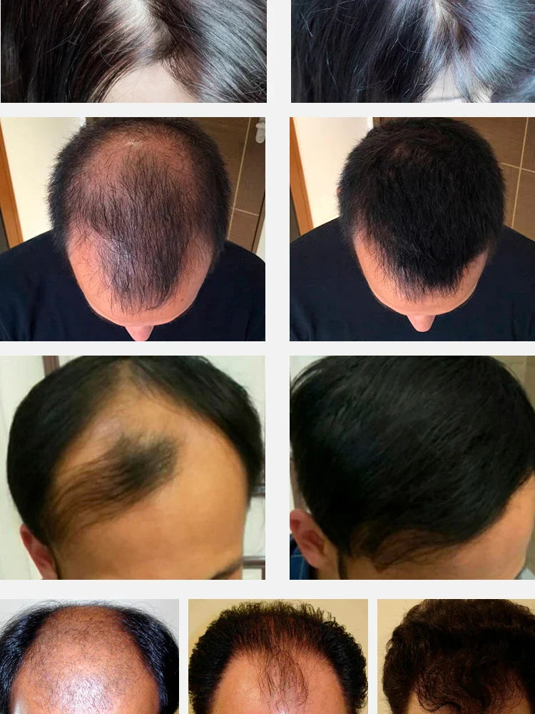 Fast Hair Growth Hair Growth Oil Effective Baldness