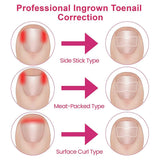 50/100pcs Ingrown Toenail Corrector Patches Nail Correction Care