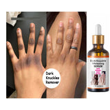 Get Rid Of Dark Knuckles In 7 Days