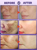 Whitening Freckle Cream Dark Spot Remover Deep Melasma