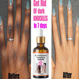 Get Rid Of Dark Knuckles In 7 Days