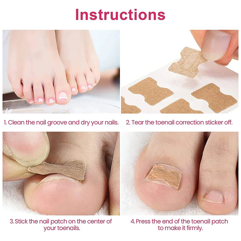 50/100pcs Ingrown Toenail Corrector Patches Nail Correction Care